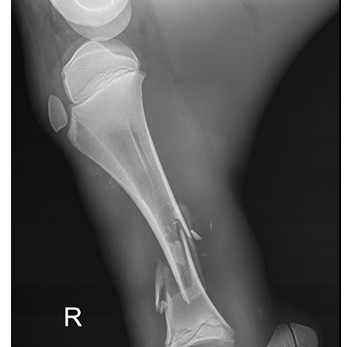 Xray of a fracture